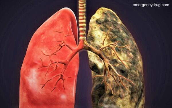 Causes of Lung Cancer disease part 2