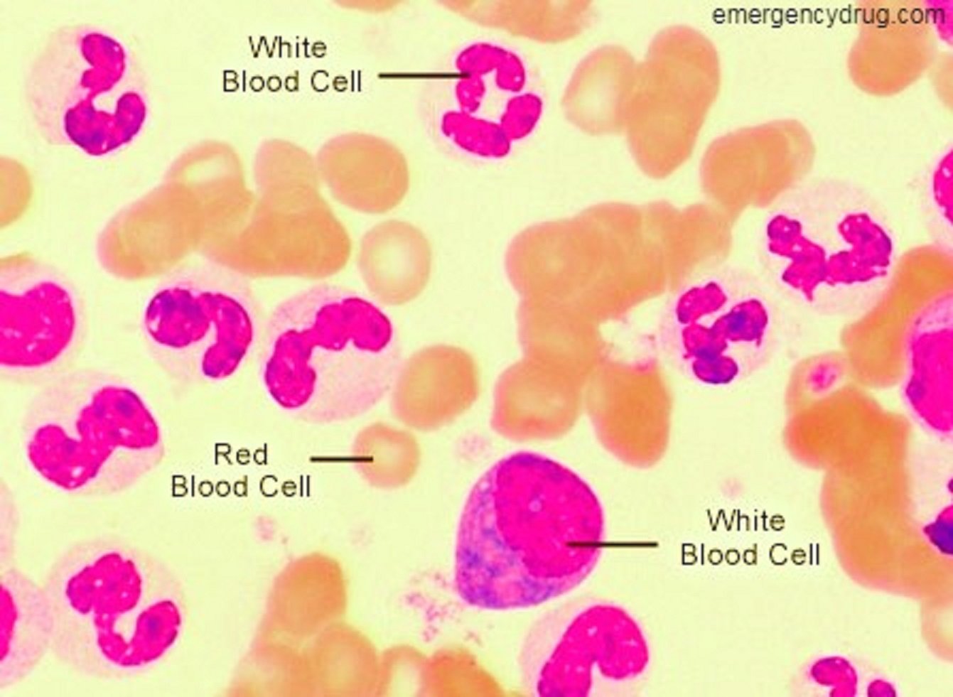 What Is Chronic Myeloid Leukemia Part 1 Emergency Drug Leukemia