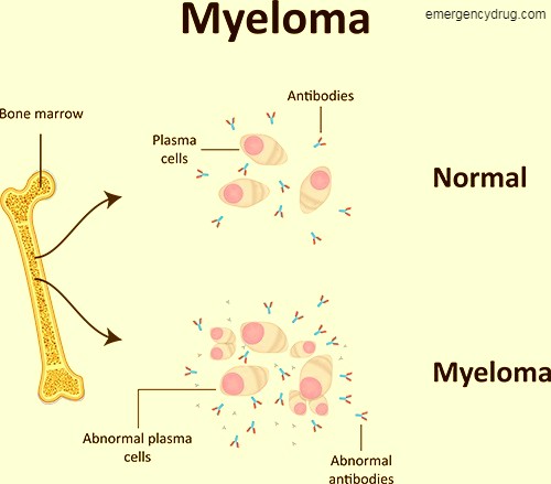 Multiple Myeloma Symptoms, Diagnosis and Treatment