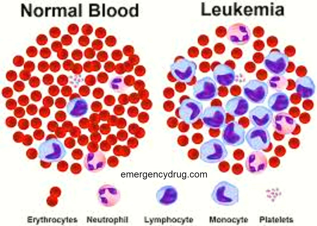 Chronic Myeloid Leukemia Part 2