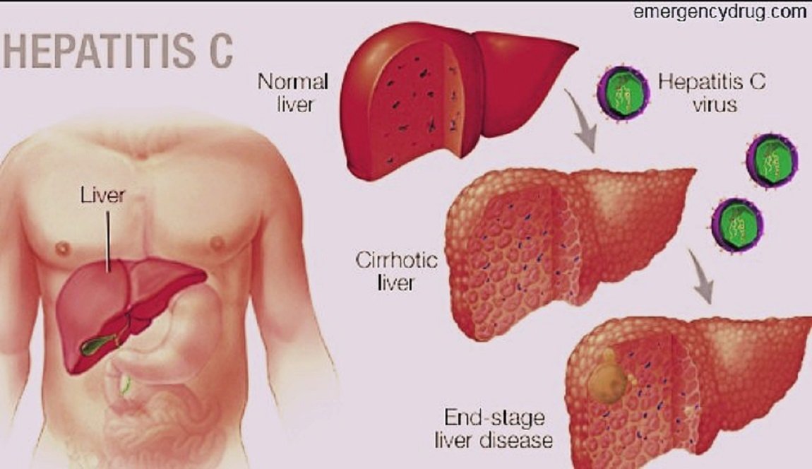 Hepatitis C infection