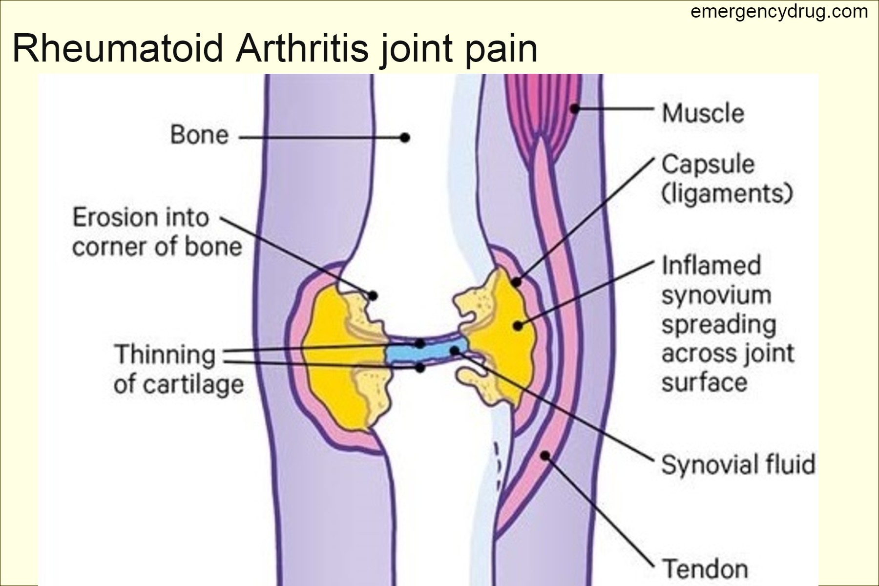 Rheumatoid Arthritis joint pain