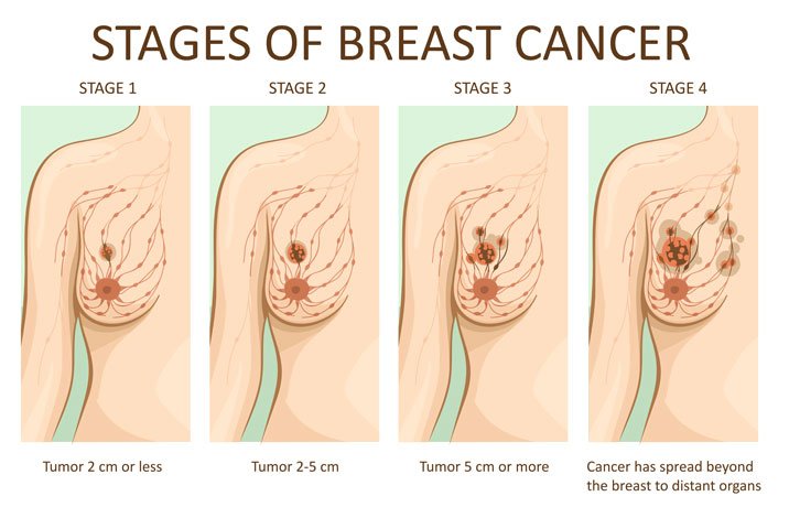 stages of breast cancer