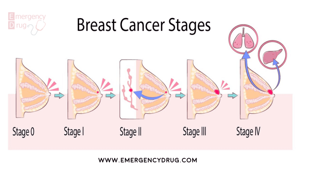 breast-cancer-stages