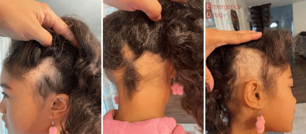 Types of Alopecia in Young Women