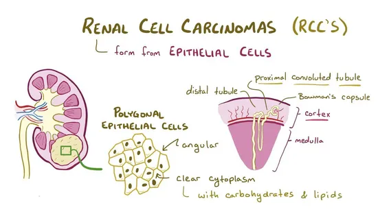 Advanced renal cell carcinoma