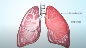 What Are the Symptoms of Stage 1 Lung Cancer