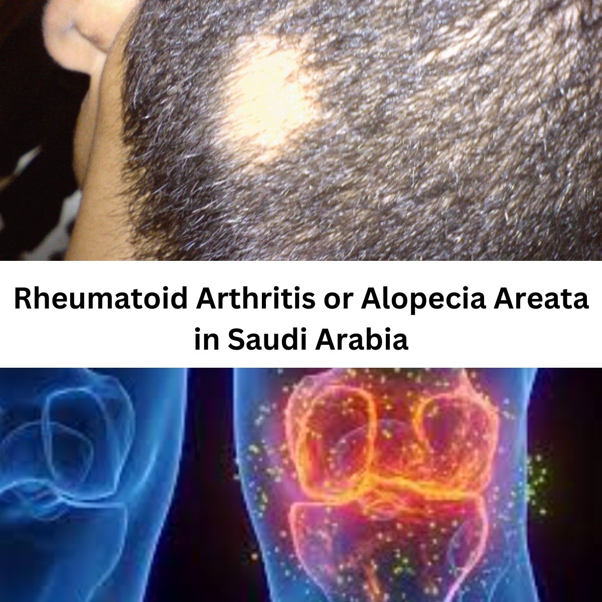 Rheumatoid Arthritis or Alopecia Areata in Saudi Arabia; Rheumatoid Arthritis; Rheumatoid Arthritis; Saudi Arabia