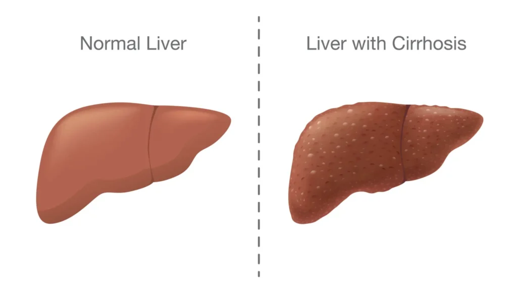 Healthy-liver-vs-liver-cirrhosis-comparison-Hepatitis-B-progression